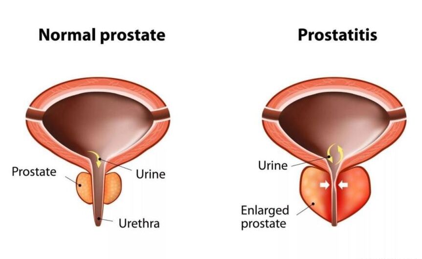 Normálna prostata a zapálená