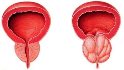 Zdravá a zapálená prostata s prostatitídou